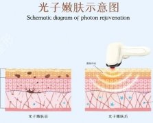 光子嫩肤的效果会反弹吗