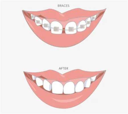 矫正牙齿整个过程痛吗？了解矫正牙齿的过程和疼痛感受！